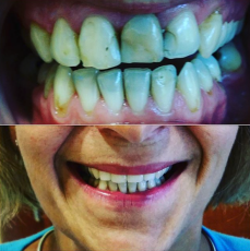 Bliss Dental et Miami Beach Smiles - Dentisterie 2
