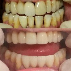 Bliss Dental et Miami Beach Smiles - Dentisterie